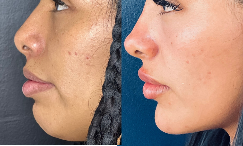Medicina estetica, botox, acido hialuronico, dermatologia, dermatologo, medico estetico, belleza, cirugia plastica, tratamiento sin cirugia, rejuvenecimiento, bioestimuladores, cuidado de la piel