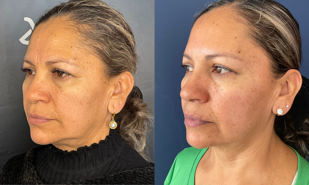 Medicina estetica, botox, acido hialuronico, dermatologia, dermatologo, medico estetico, belleza, cirugia plastica, tratamiento sin cirugia, rejuvenecimiento, bioestimuladores, cuidado de la piel