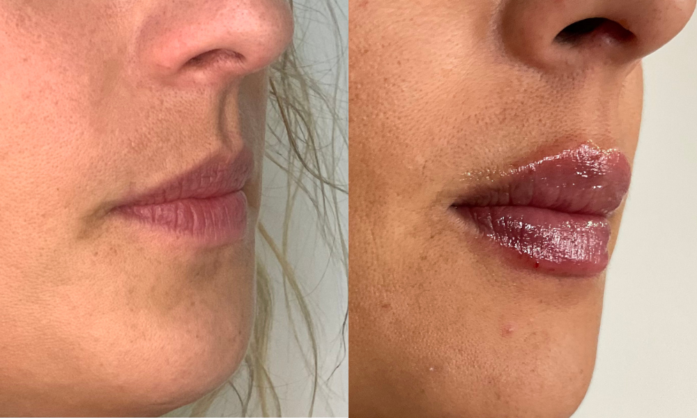 labios, relleno labial, ácido hialurónico, cirugía, salud, belleza,medicina estetica, queretaro