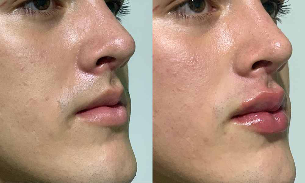 labios, relleno labial, ácido hialurónico, cirugía, salud, belleza,medicina estetica, queretaro