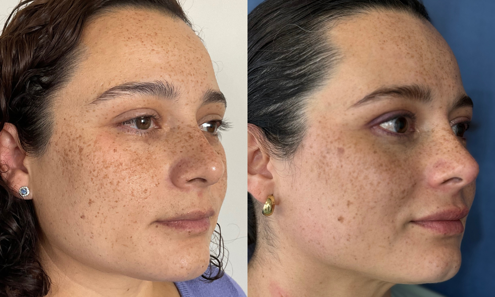 Medicina estetica, botox, acido hialuronico, dermatologia, dermatologo, medico estetico, belleza, cirugia plastica, tratamiento sin cirugia, rejuvenecimiento, bioestimuladores, cuidado de la piel