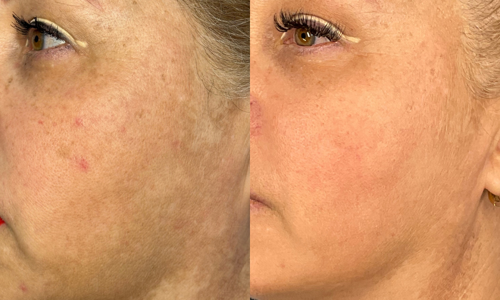 Medicina estetica, botox, acido hialuronico, dermatologia, dermatologo, medico estetico, belleza, cirugia plastica, tratamiento sin cirugia, rejuvenecimiento, bioestimuladores, cuidado de la piel