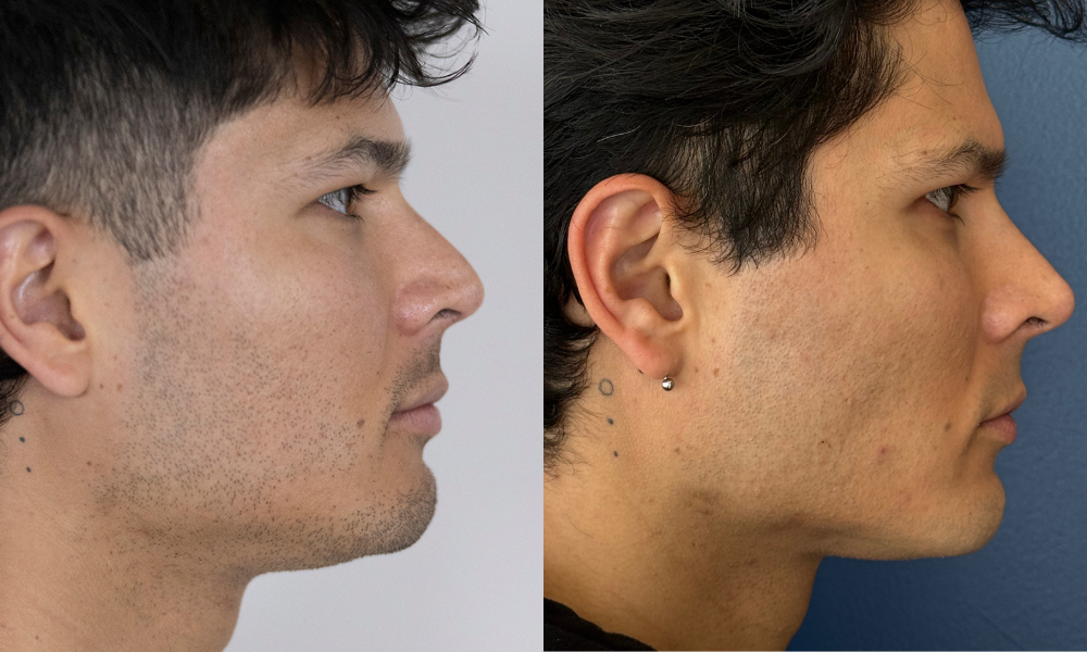 labios, relleno labial, ácido hialurónico, cirugía, salud, belleza,medicina estetica, queretaro