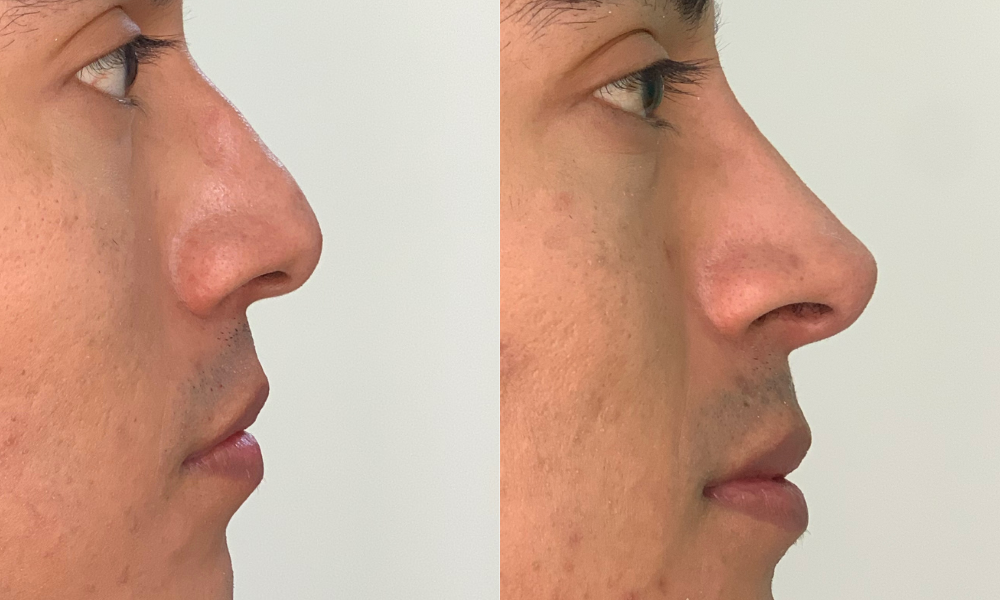 labios, relleno labial, ácido hialurónico, cirugía, salud, belleza,medicina estetica, queretaro