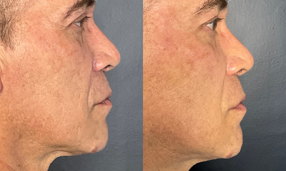 labios, relleno labial, ácido hialurónico, cirugía, salud, belleza,medicina estetica, queretaro