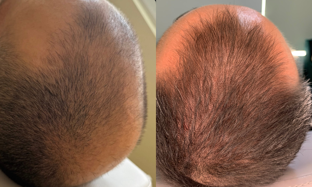 Alopecia, tratamiento capilar, injerto de cabello 